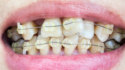 A Importância da Correção da Posição dos Dentes Antes do Tratamento de Prótese Dentária.