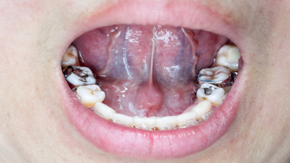 A Importância da Correção da Posição dos Dentes Antes do Tratamento Definitivo de Restaurações Dentárias.